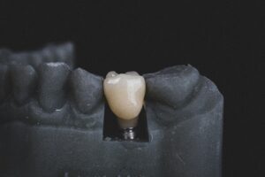 Dental Implants: Enhancing Recovery